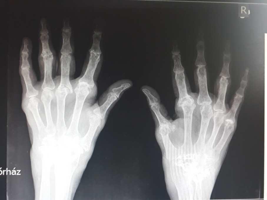 11.) ábra: AP Rtg. felvétel a csuklókról és kezekről. A kéz csontjain atrophia figyelhető meg, az interphalangealis rések szűkebbek.