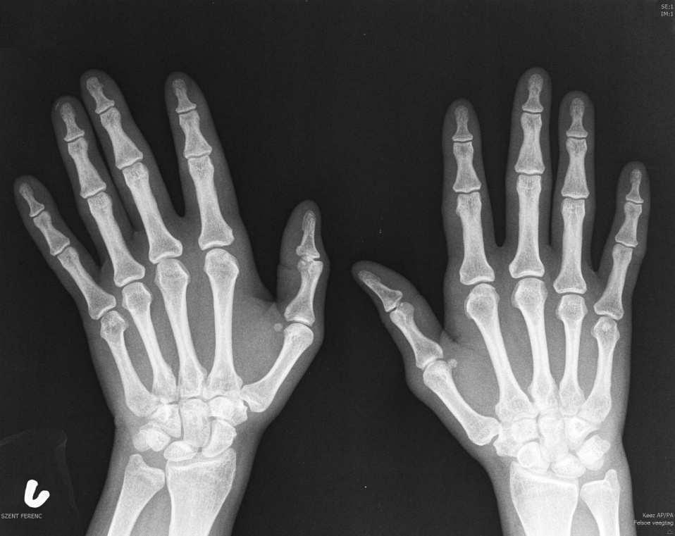 Rheumatoid arthritis kezelése az ujjak ízületeiben - CSID videó