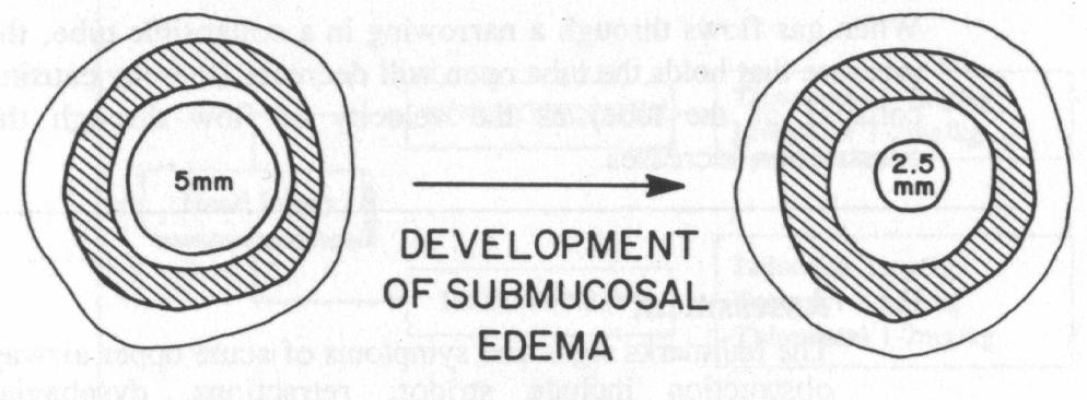 2 Croup A croup szindrómába lefolyásukat, súlyosságukat tekintve jelentősen különböző kórképek tartoznak. A bacterialis tracheitis és az epiglotittis életveszélyes kórkép - intenzív osztályra!