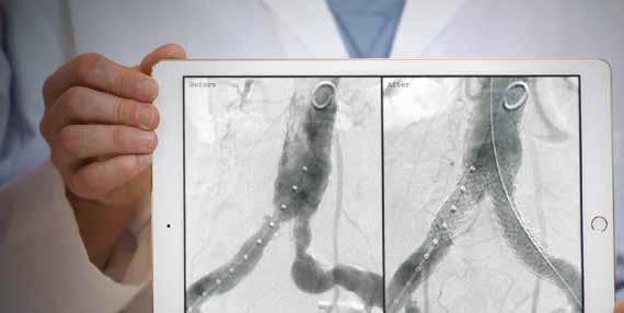 cases, including: 1 Tortuous vessels Aortic bifurcation lesions TASC II C & D lesions Severely calcified lesions Total occlusions Complex Aortic Aneurysms View