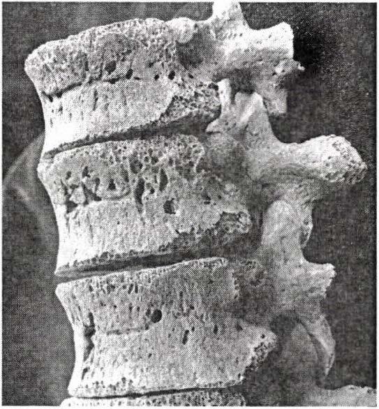 , férfi). Figure 15: Abnormal vascularisation on the anterior surface of the thoracic vertebral bodies (Grave no. 33, Juv., male). 16.