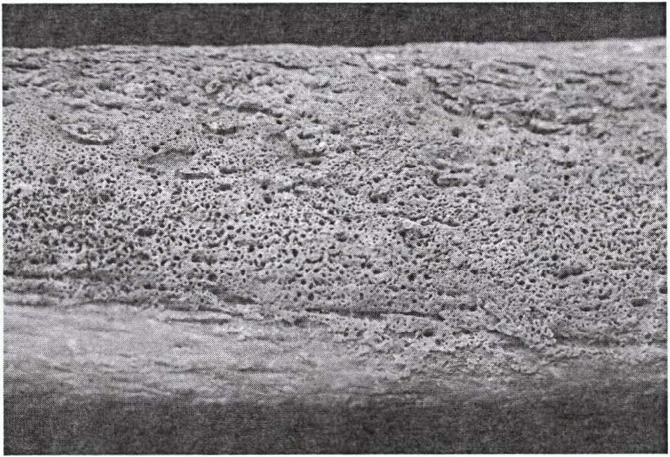 6. ábra: Kiterjedt periostitis a bal tibia diafízisén (6. sír, Mat., nő).