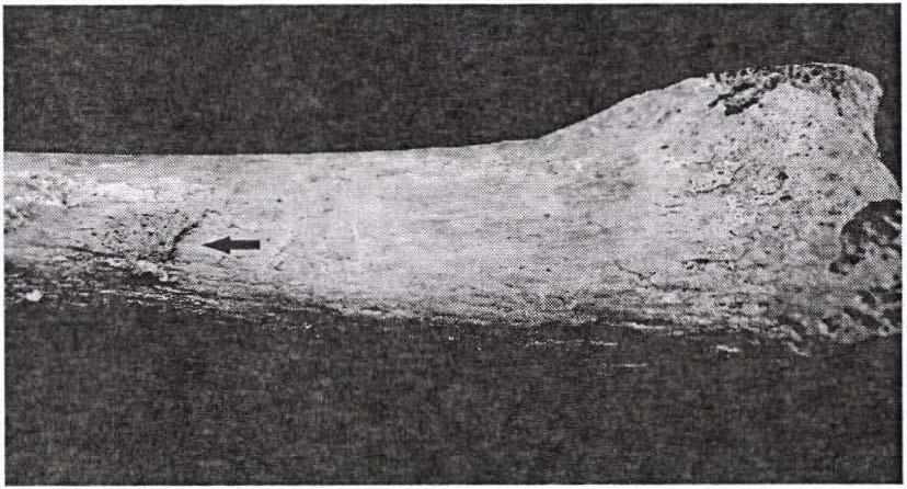 6, Mat, female). 7. ábra: Periostitis (nyíl) a jobb radius distalis részén (6. sir, Mat.
