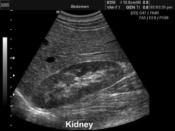 Húgyúti fertőzések Gyakorlati kérdések, nehézségek: képalkotó vizsgálatok -UH (olcsó, nem invazív) -DMSA (hegek kimutatása) -cystographia (VUR kimutatása, de: