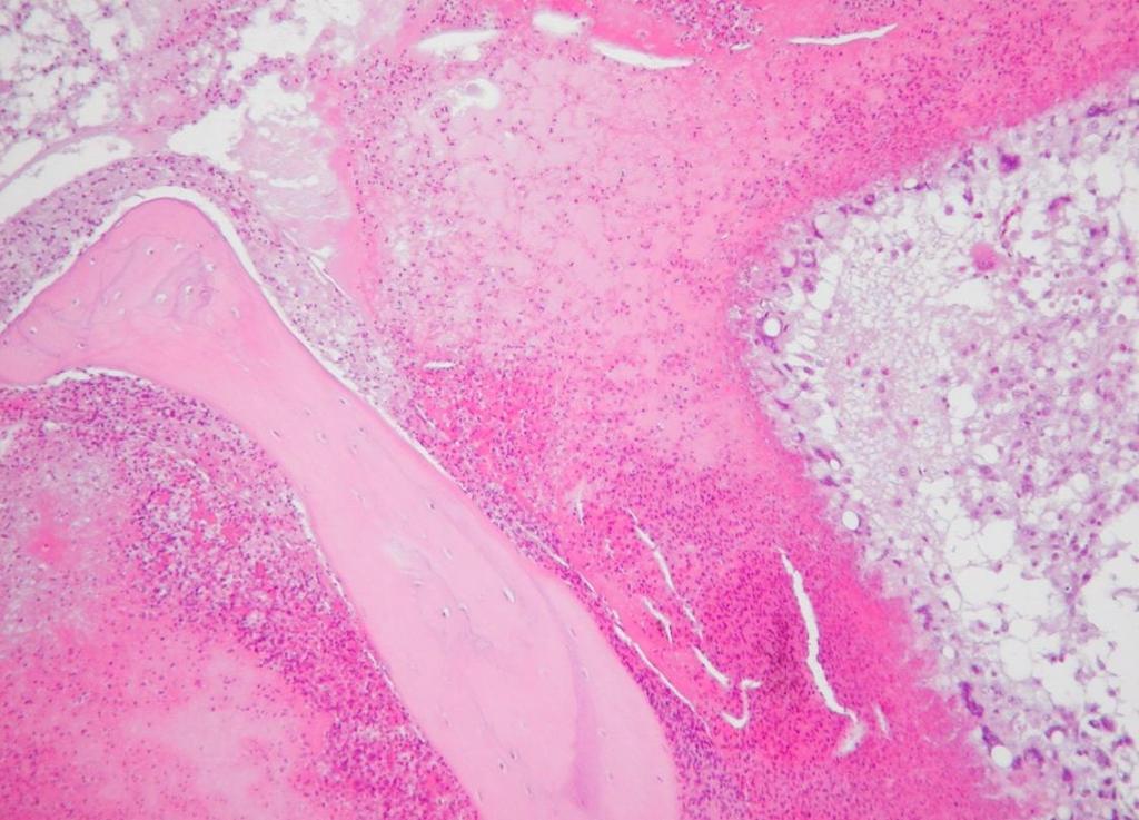 11. ábra: Heterophil granulocytás beszűrődéssel járó savós-gennyes osteomyelitis a koponyacsontban, pulykában (H.-E.) 200x 5.
