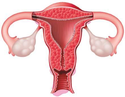 disseminált intravascularis coagulatio következményeként, hyperfibrinolysis, fokozott vérkiürülés.