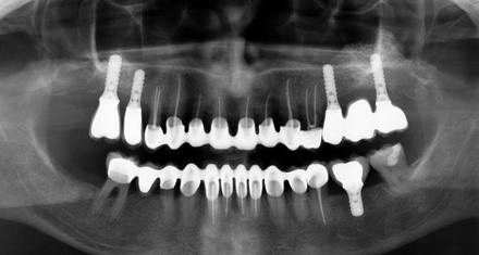 implants in the
