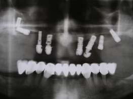 implantátumok felszínét (Koka et al. 1993; Mombelli et al.1995, Gouvoussis et al.