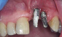 TÚLÉLÉS SIKERESSÉG Túlélési arány implantátum a szájban van Elvesztési arány implantátum már kikerült a szájból Sikerességi arány implantátum funkcióban van és