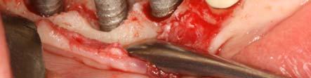 1986) Absence of a continuous radiolucency around the implant (Buser et al. 1990, Albrektsson et al.