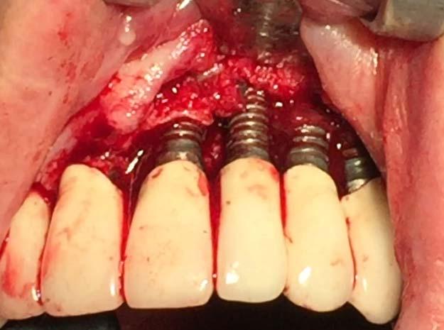 1986) No PPD>5mm at implant sites (Mombelli & Lang 1994; Bragger et al.