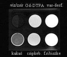 A zsírelnyomásos 3D FSPGR szekvenciával készült felvételeken a kakaó közepes jelintenzitása jelentősen eltért (CNR > 40) a víz és a zsír alacsony, valamint a Gd-DTPA magas