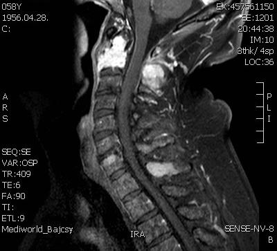 MRI STIR