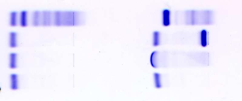 Bence-Jones fehérje Urine Electrophoresis Urine