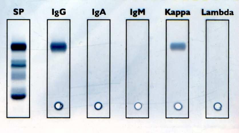 MGUS Paraproteinaemia Myeloma