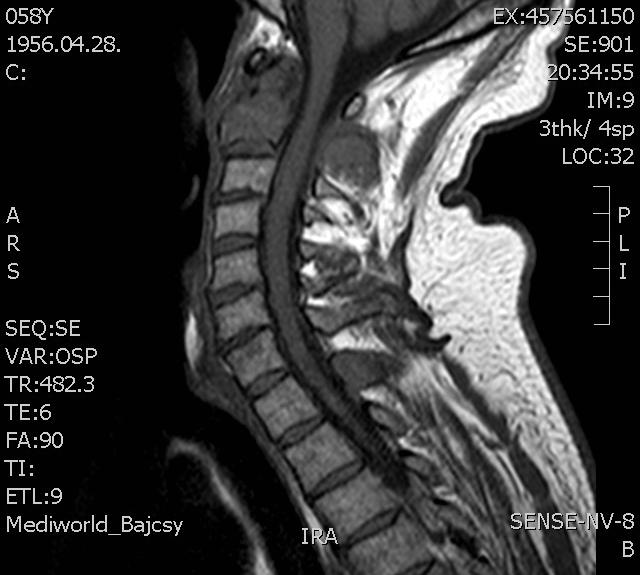 MRI (T1)