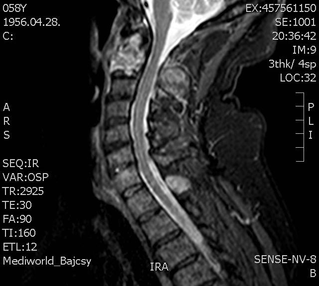 MRI (T2)