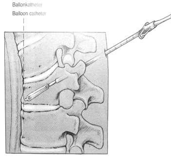 Vertebroplastica transpeduncularis úton a csigolyatestbe történő csontcement befecskendezés