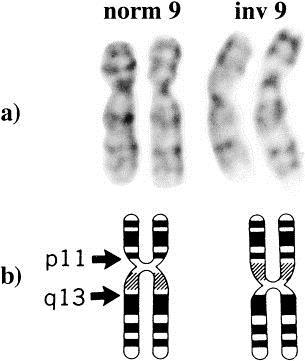 A 9-es kromoszóma pericentrikus inverziója: 46XX, inv[9] [p11q13] Lee et al. Schizophrenia Res. 1998, Vol32. Iss.2 1-3% prevalencia (normál variáns?