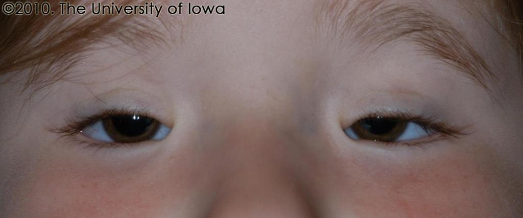 Blepharophimosis, ptosis, epicanthus inversus syndrome - ritka FOXL2, 3q23