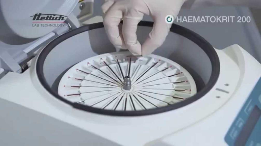 Hematocrit (Htc) mérése Legmegbízhatóbb módja a hematokrit centrifuga Automaták számított értéket adnak ki = (Vörösvérsejtszám * MCV)/1000 Feltétel: a vvt szám és térfogat mérése jó legyen Ha ezek