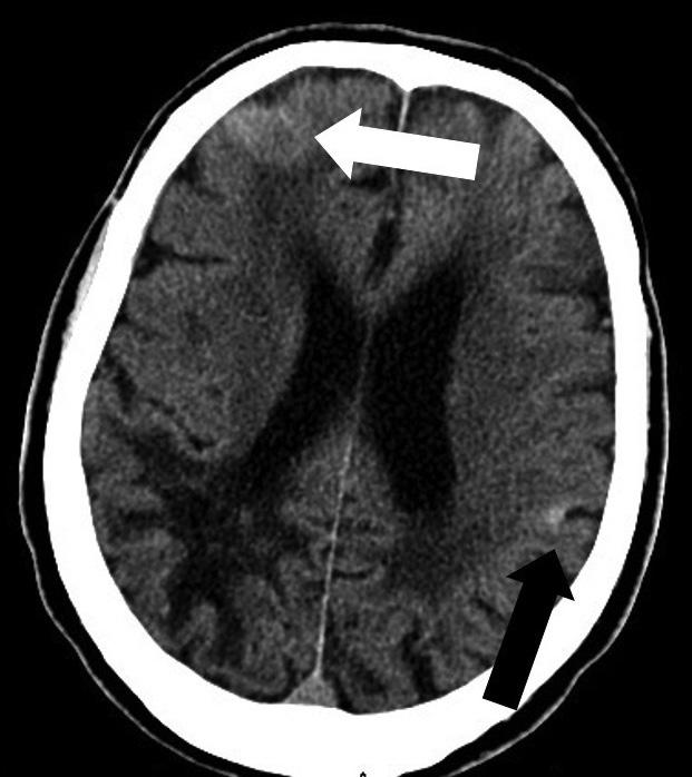 4. ábra Egy 58 éves férfi beteg elektív időpontban végzett natív koponya-ct-vizsgálatának képe. Jobb oldalon, frontalisan a subarachnoidealis térben hyperdensitas utal friss vérzésre (fehér nyíl).