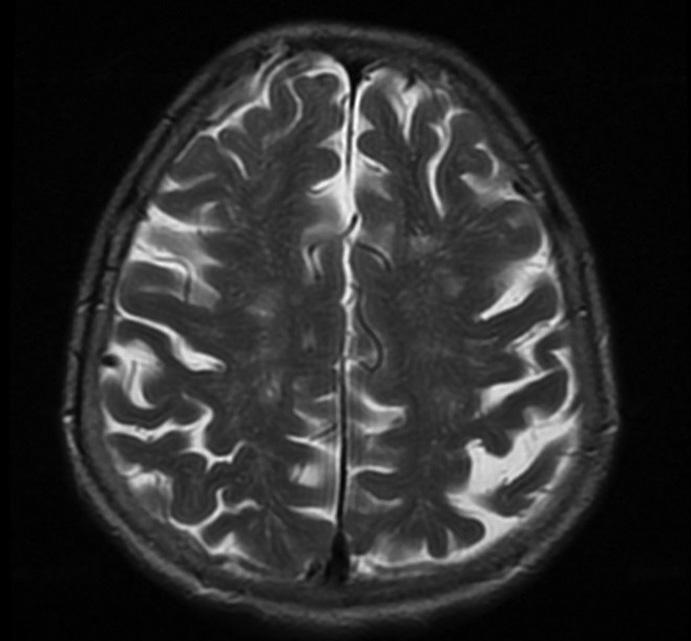 corticalis infarctusokkal és leukoencephalopathiával (CADASIL).