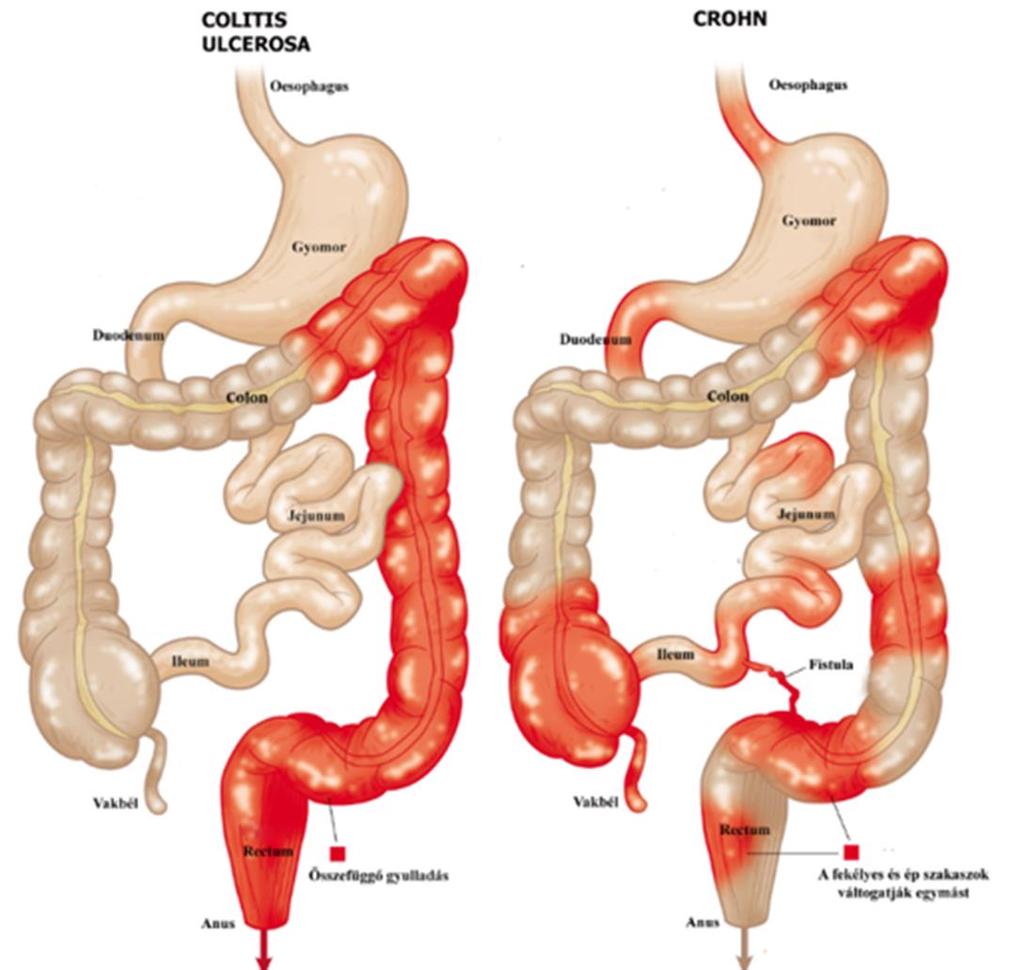 Bevezetés 17 3. ábra A., Colitis ulcerosa és Crohn-betegség előfordulása az emésztőrendszerben A kép forrása: https://www.cun.es/enfermedades-tratamientos/enfermedades/enfermedadcrohn, https://es.