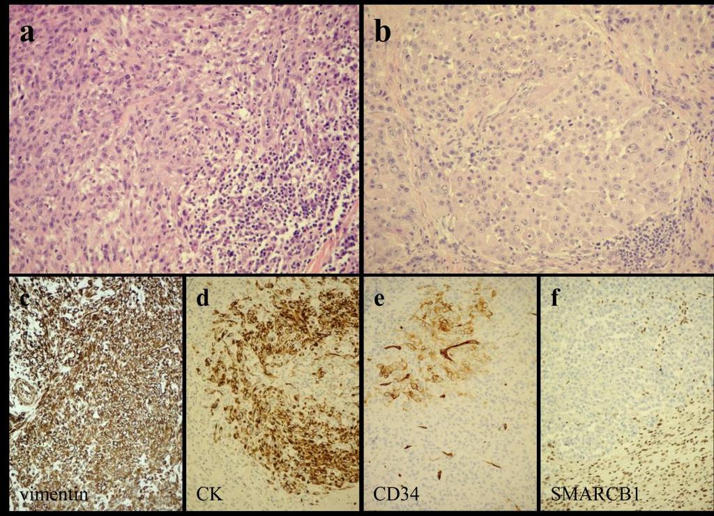 1. Ábra: Disztális (a; 20x nagyítás) és proximális (b; 20x nagyítás) típusú epithelioid sarcoma H&E