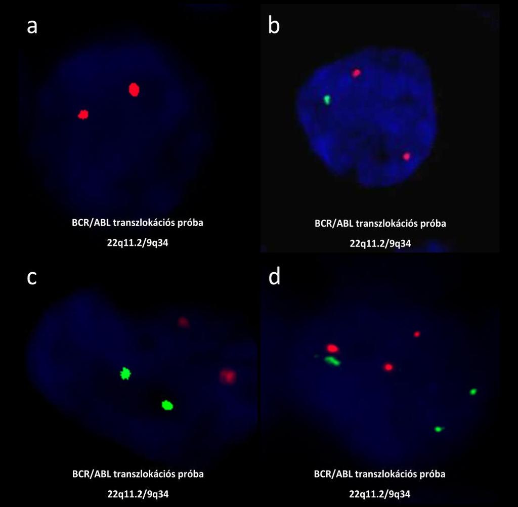11. Ábra: A FISH vizsgálat eredményei epithelioid sarcomában. A narancsszínű szignálok az ABL régiót (9q34), a zöld szignálok a BCR/SMARCB1 régiót (22q11.2) reprezentálják.