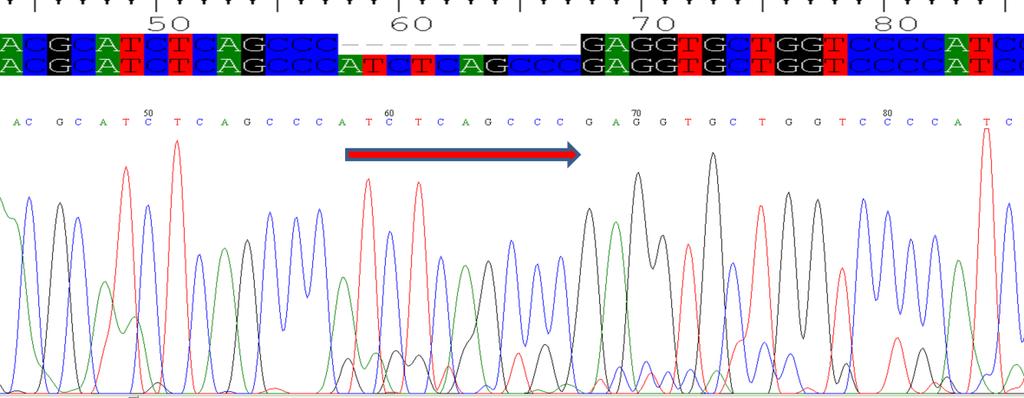 Mindössze két epithelioid sarcomában találtunk SMARCB1 mutációt, az egyik tumorban a gén 5-ös exonjában egy 10 bázispáros duplikációt (ATCCTAGCC) (12.
