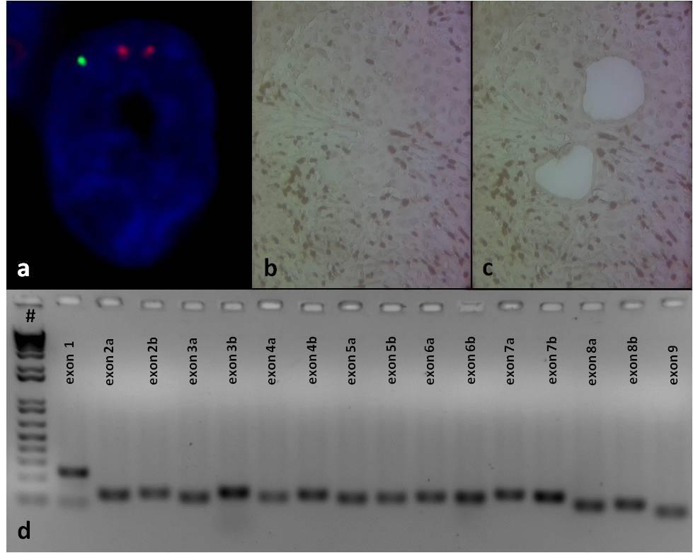 14. Ábra: FISH eredmények PCR validációja. Monoallelikusan deletált epithelioid sarcoma FISH eredménye (a). SMARCB1 immunhisztokémia lézer mikrodisszekciót megelőzően (b; 40x nagyítás).