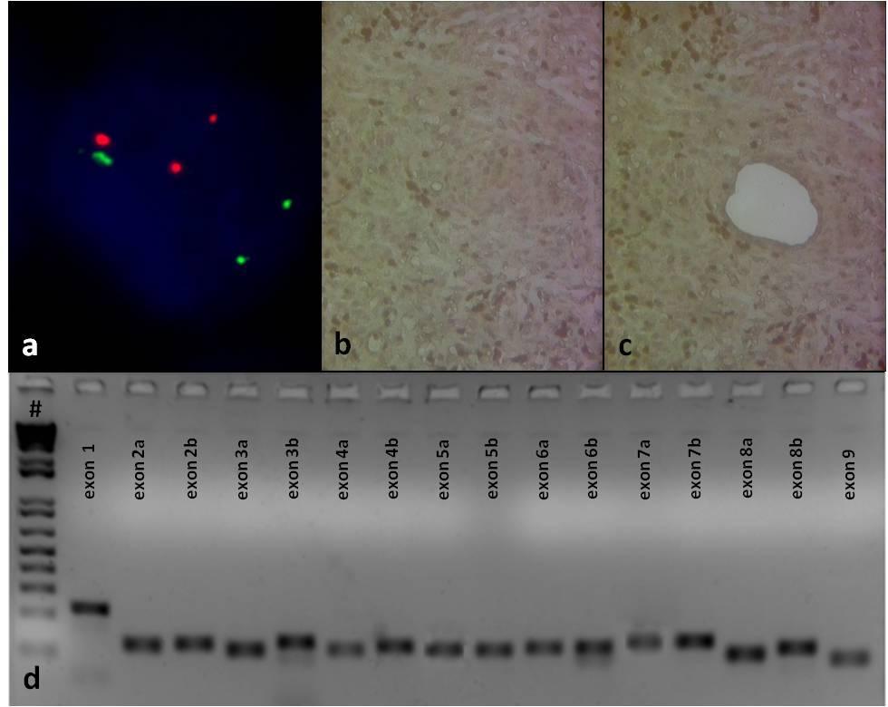 15. Ábra: FISH eredmények PCR validációja. Deléciót nem mutató, SMARCB1 vad típusú epithelioid sarcoma FISH eredménye (a). SMARCB1 immunhisztokémia lézer mikrodisszekciót megelőzően (b; 40x nagyítás).
