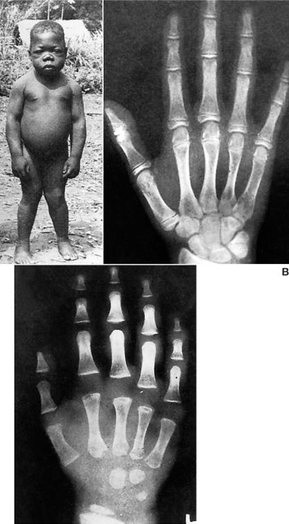 Tünetek Abnormális mielinizáció, szinapszis képződés Mentális retardáció Buta arckifejezés Reflex lassulás Süketség Izomgyengeség Lassú mozgás Csökkent izomtónus,