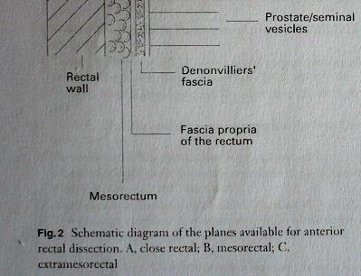 rectal cancer surgery. Heald RJ.