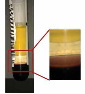 IgG-λ M-protein jelenléte Monoclonalis gammopatia - Csökkent Ig szekréció, sérült vérképzés, anémia, alvadászavarok, osteolitikus csontléziók, hiperkalcémia, vesekárosodás - Hemosztázis zavara: