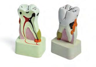 Egyéb Szemléltető modell (KKD) Tanulmánymodell fogbetegségek, implantátum munkák, hidak, koronák, inlay-k szemléltetésére.