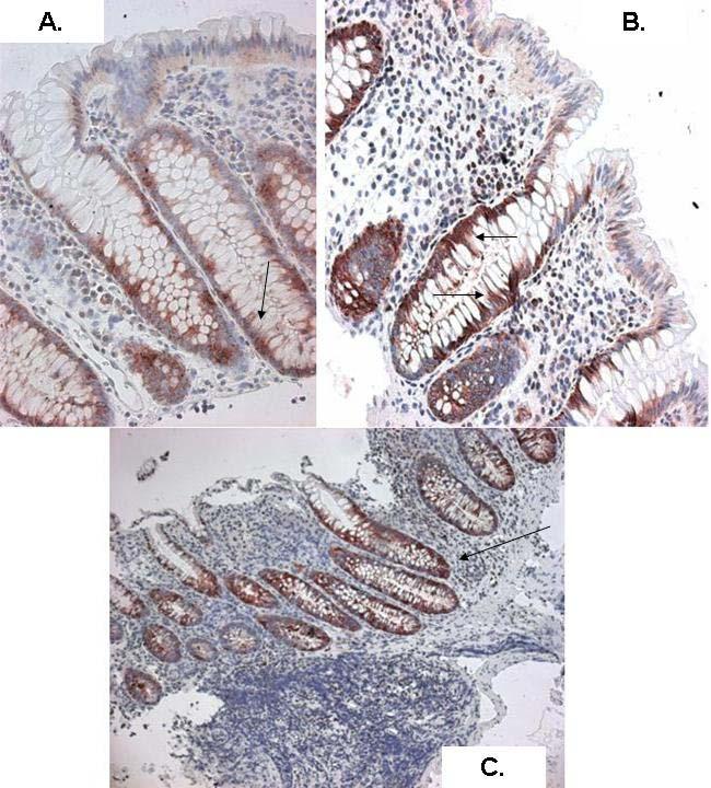 aktív colitis ulcerosa (200x nagyítás); E: súlyosan aktív Crohn-colitis (200x nagyítás). A barnás-fekete sejtmagok (nyilak) TUNEL-pozitívak (TUNEL-diamino-benzidin, hematoxylin). 7.2. PCNA expresszió Egészséges mintákban a PCNA pozitív hámsejtek a crypták alsó 1/3 részében helyezkedtek el (8/A.