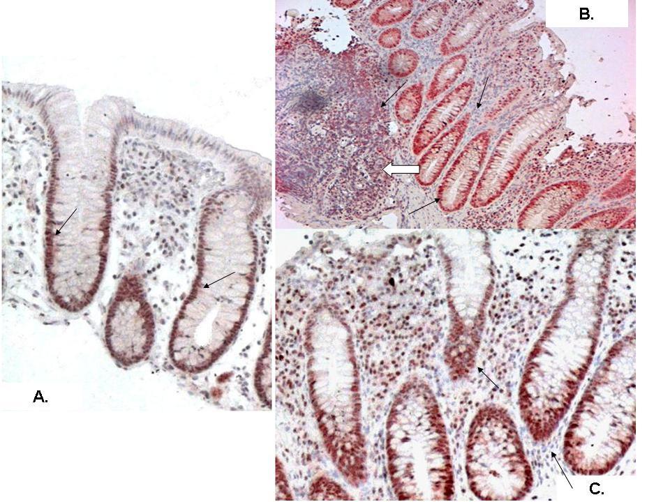 9. ábra: p53 expresszió egészséges és gyulladásos vastagbélhámban A: Ép vastagbél crypta (200x nagyítás); B: Súlyos aktivitású colitises minta (100x nagyítás).