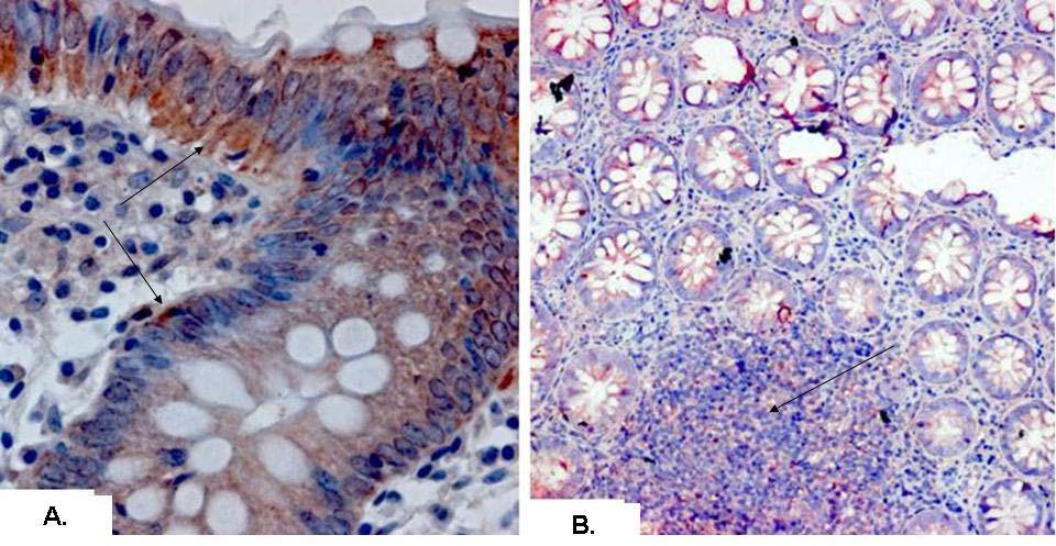 13. ábra: C-met/HGFR expresszió colitis ulcerosában A: enyhe gyulladás (fekete nyilak); B: HGFR pozitív sejteket tartalmazó lymphoid aggregátum (fekete nyíl).