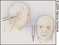 Rinne-teszt 1 fül lég- és csontvezetésének összehasonlítása Normál hallás: Légvezetéssel jobban hallja Rinne pozitív (R +) Vezetéses hcs: Csontvezetéssel jobban