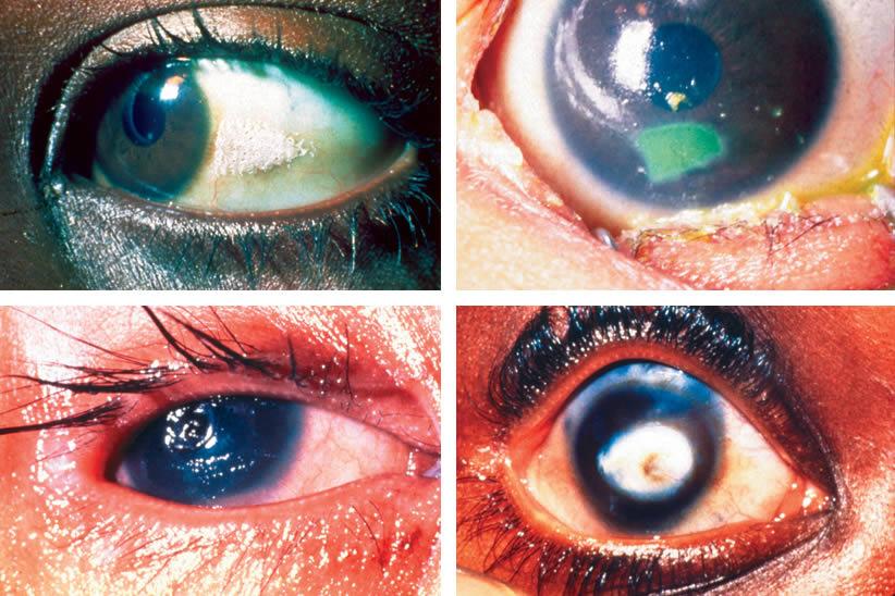 Xerophthalmia D-vitamin (antirachitiszes vit.