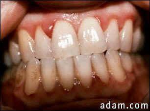C-vitamin (ascorbinsav, antiskorbut vitamin), Hiánytünetek: skorbut, Möller-Barlow kór hipovitaminozis; vérzések (gingiva, izületek) immunhiány, a prolinszintézis zavara Hatásmechanizmus: