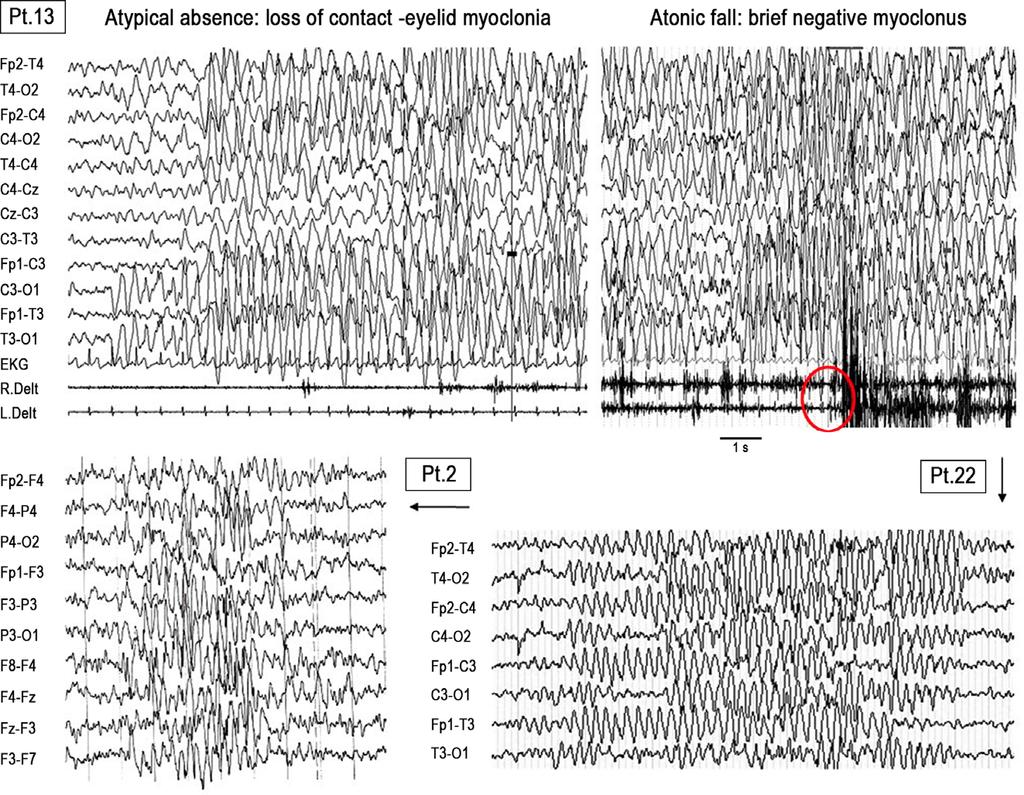 JOHANNESEN ET AL. 399 F I G U R E 3 Similar EEG pattern in 3 different patients diagnosed as MAE-like (Patient 20), unclassified generalized (Patient 2), and typical MAE (Patient 31).