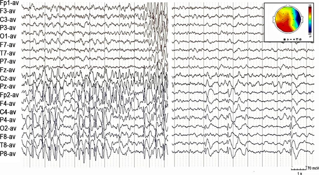 400 JOHANNESEN ET AL. FIGURE 4 Nocturnal sleep EEG in Patient 26 at the age of 4 y and 5 mo.