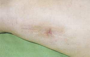 (1963.) 4. 4. Hatz, R. A., Schildberg,.J. F. W.: Mechanisms of action of collagenase in wound repair.