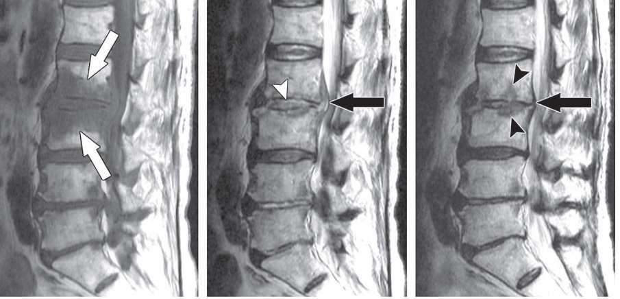 Pyogen spondylitis.