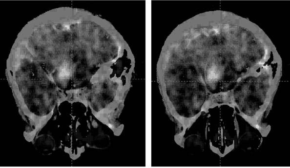 Korszerû eljárások az idegsebészeti diagnosztikában és terápiában 2. ábra Agytörzsi A1 astrocytoma CT-PET fúziója. H. R. nõbeteg, sz:. 1953. 1999. 04.