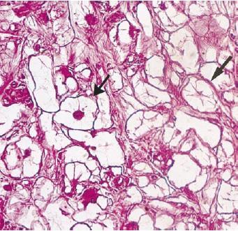 Rhabdomyoma szájfenék, nyelv, általában fej-nyak régió,