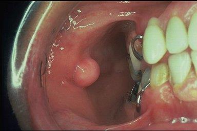 Fibroma